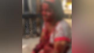 Mulher Sofre Ataque Violento do Próprio Cachorro em Itagimirim