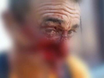 Colisão no Veloso deixa homem desfigurado após acidente de moto -PB