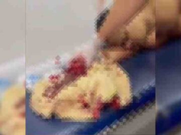 Discussão por moto termina com mão decepada em Carpina; suspeito fugiu