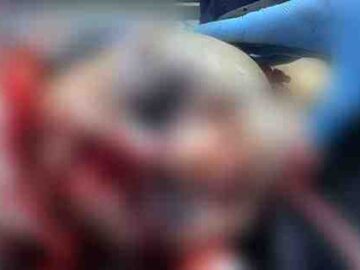 Acidente de trânsito deixa paciente com traumatismo craniano grave